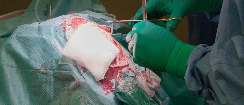 Podczas operacji mózgu usunięto guza, który ważył rekordowe 1,9 kg
